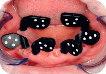 PIC transfers combination